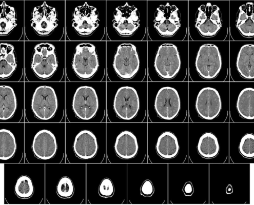Catastrophic Brain Injury